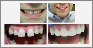 before and after Cosmetic Bonding Pearl Dental Arts four images