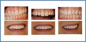 Before and After Cosmetic Teeth bonding by Dr. Paghdiwala Levittown PA