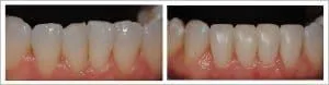 Before and after Cosmetic dentist Dr. Paghdiwala of Levittown PA does dental bonding