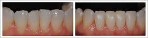 Before and after Cosmetic dentist Dr. Paghdiwala of Levittown PA does dental bonding