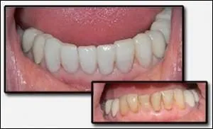 Before and after cosmetic bonding of teeth by Dr Paghdiwala Levittown PA 19056
