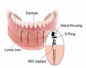 illustration of mini dental implants
