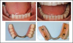 before and after mini dental implants