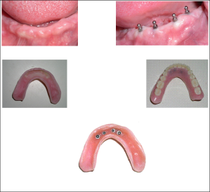 patients mouth with mini dental implants 