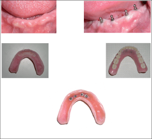 patients mouth with mini dental implants