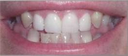 After porcelain veneers