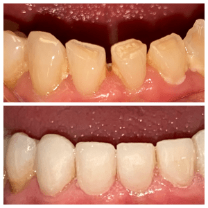 Before and after Cosmetic teeth bonding Levittown PA 19056