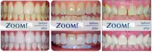 oom in-office 1 hour teeth whitening results