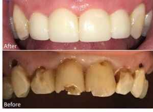 Smile makeover with porcelain veneers and teeth bonding