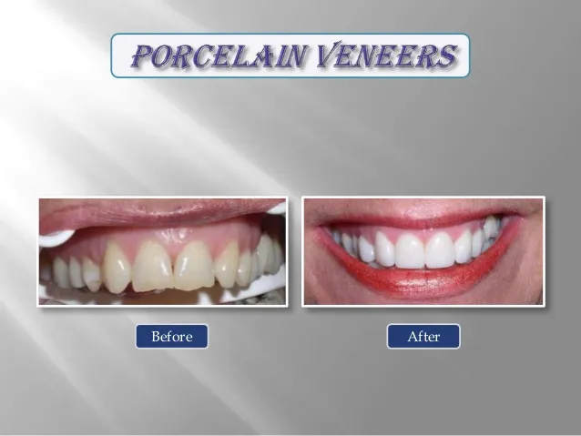Before and after porcelain veneers smile