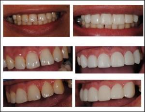 Before and after Cosmetic Bonding Dr Paghdiwala six images