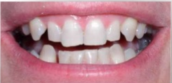 Before porcelain veneers