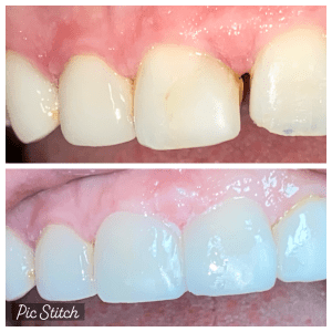 Before and after teeth whitening