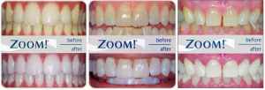 oom in-office 1 hour teeth whitening results