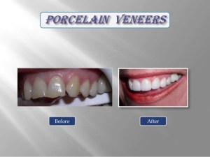 cosmetic  dentist  in  Levittown  offers  porcelain  veneers