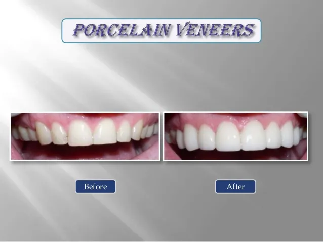 Before and after porcelain veneers